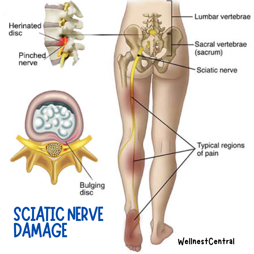 Read more about the article Can Sciatica Cause Knee Pain? Uncover the Hidden Link to Find Lasting Relief from Pain and Frustration