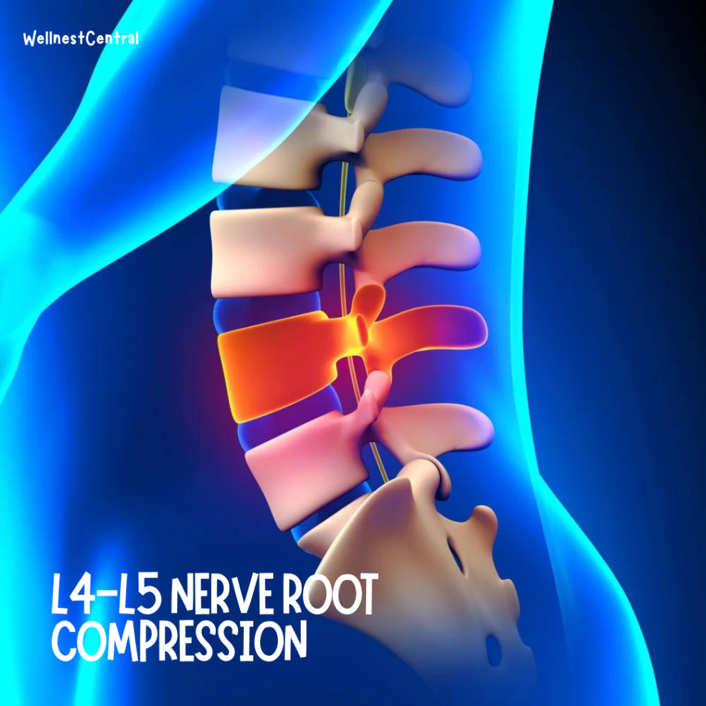 L4-L5 Nerve compression: Can sciatica cause knee pain?
