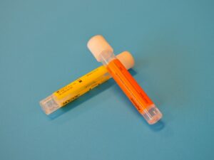 Read more about the article Blood in Urine on a Test: What Does Microscopic Hematuria Mean?